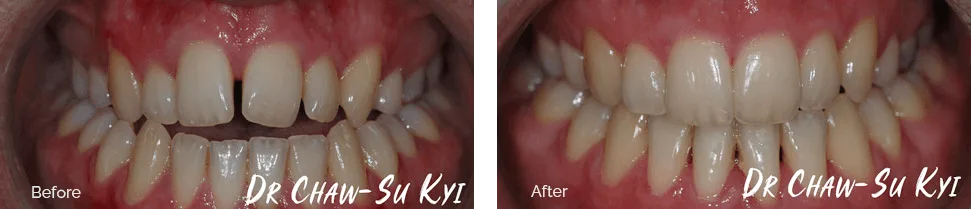 Before and after orthodontic treatment - case 1