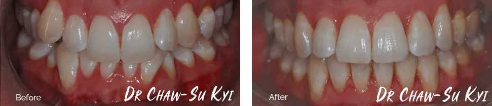 Before and after orthodontic treatment - case 2