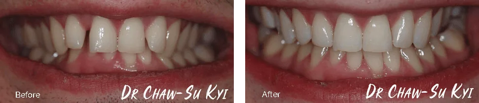 Before and after orthodontic treatment - case 3