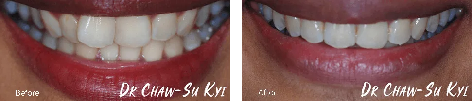 Before and after treatment - case 1