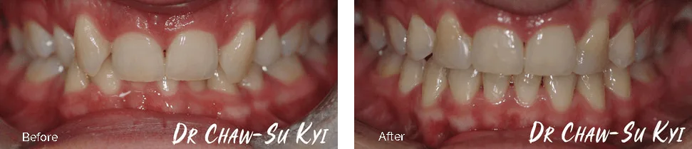 Before and after treatment - case 2