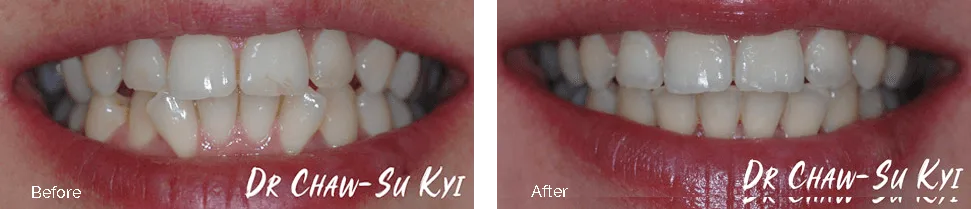Before and after treatment - case 3