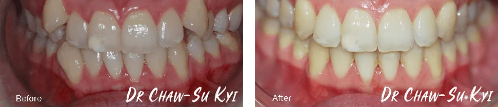 Fixed braces before and after