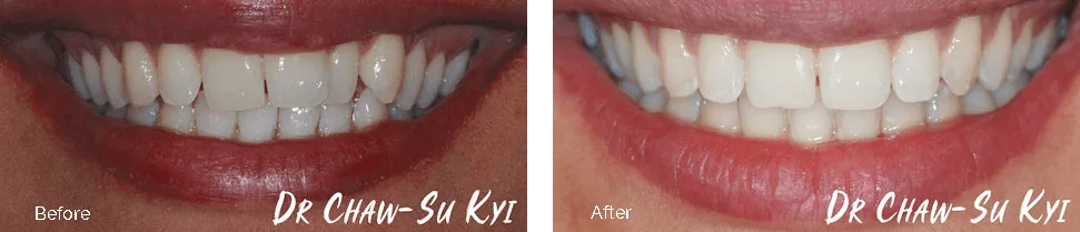 Before and after treatment - case 2