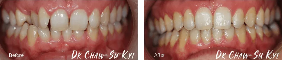 Before and after treatment - case 3