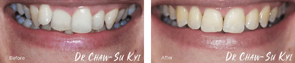 Adult braces before and after