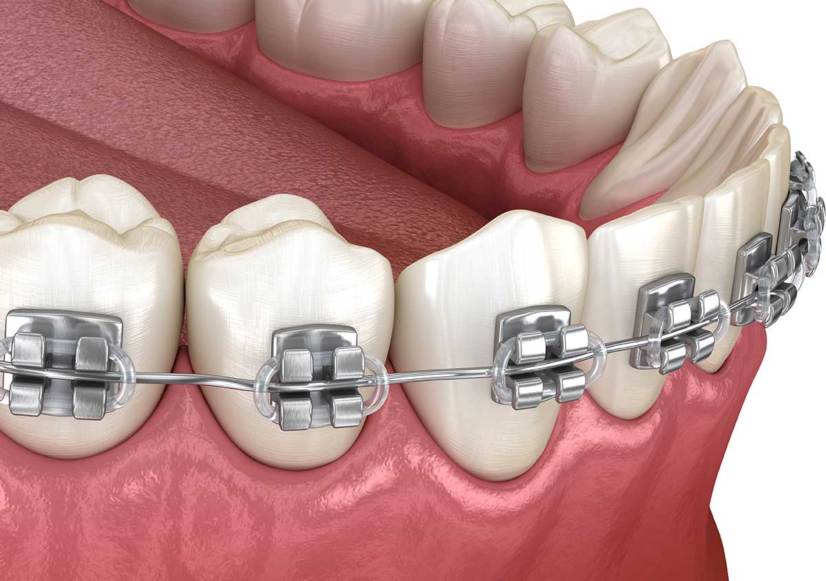 Smiling patient discussing modern orthodontic treatment options with their dentist in West London