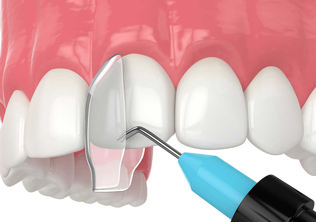 Close-up of a patient's smile after composite bonding treatment to repair chipped teeth in West London