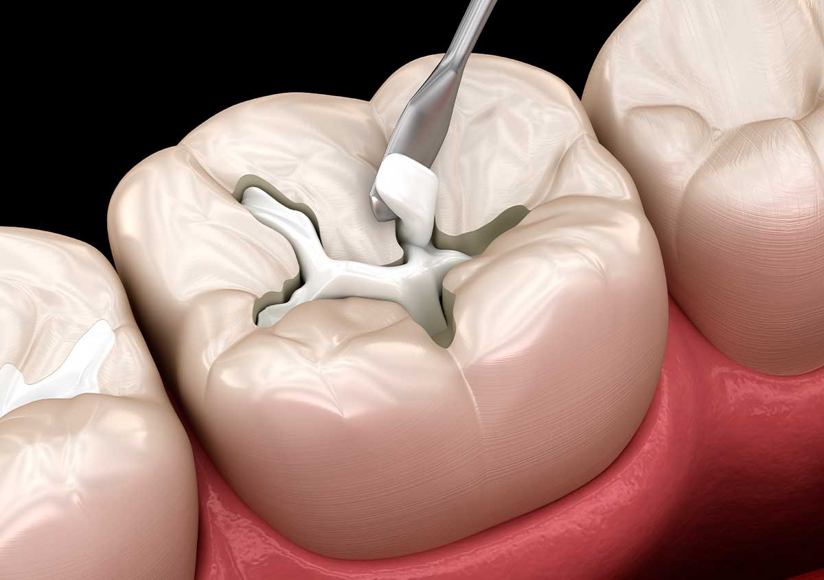 Close-up of a composite dental filling restoration at West London Orthodontist