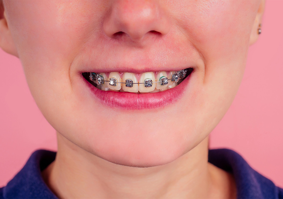 Child smiling while holding a clear Invisalign aligner for kids in West London
