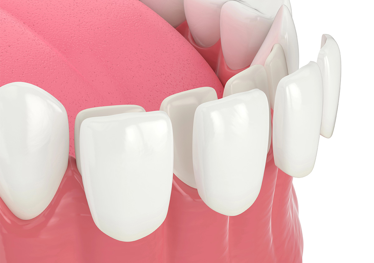 Natural-looking porcelain veneers created for a patient at West London Orthodontist Cosmetic Dental Studios