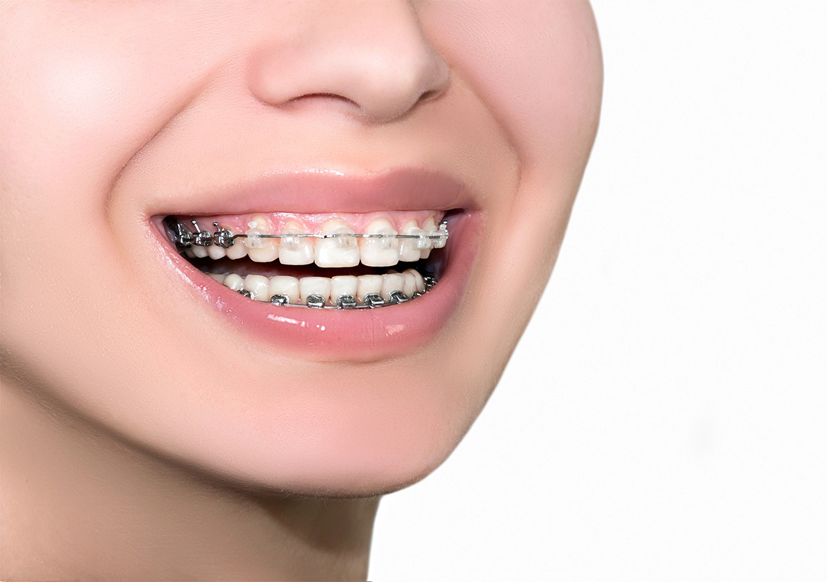 Private orthodontist consultation comparing NHS and private braces treatment in West London