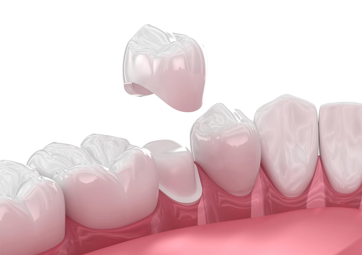 Dental porcelain crown procedure at West London Orthodontist Cosmetic Dental Studios