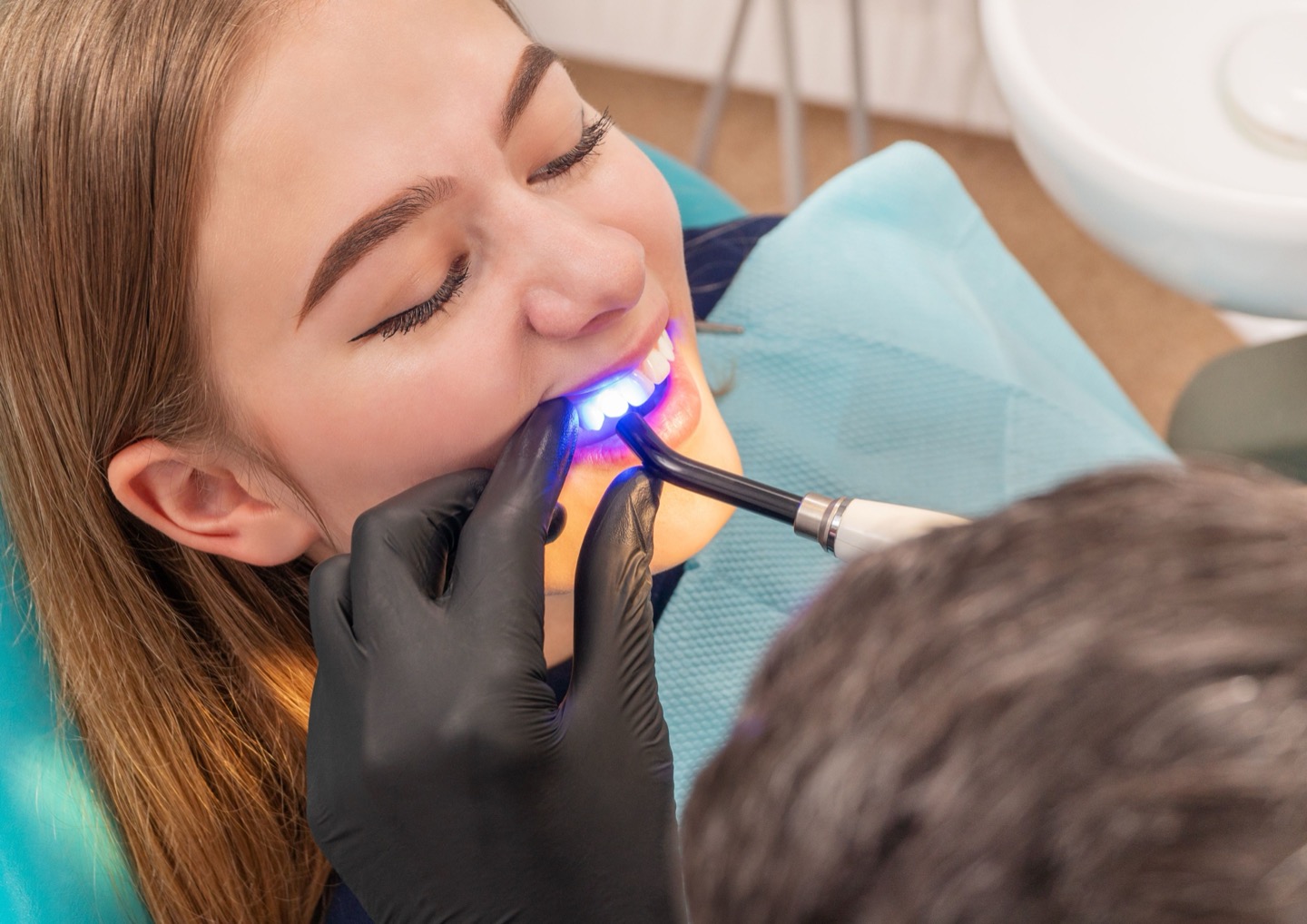 A curing light setting composite bonding on a patient&rsquo;s front teeth