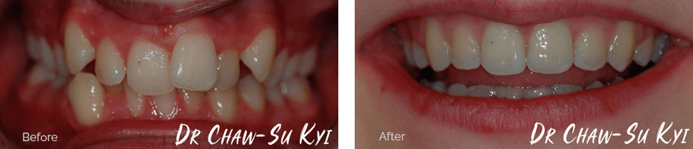 Children&rsquo;s Braces Before After Case 01