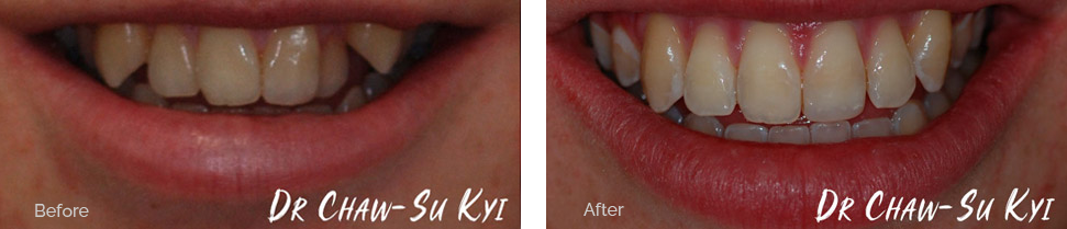 Children&rsquo;s Braces Before After Case 02