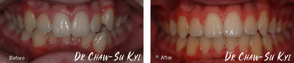 Children&rsquo;s Braces Before After Case 03