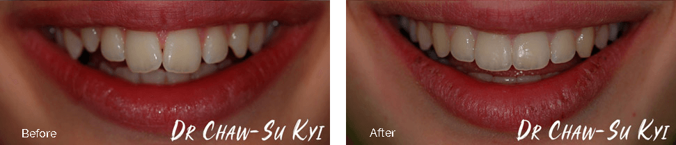 Children&rsquo;s Braces Before After Case 04