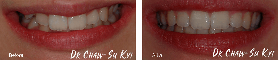 Children&rsquo;s Braces Before After Case 05
