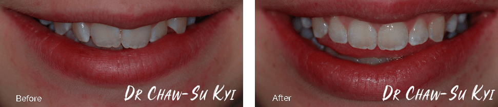 Children&rsquo;s Braces Before After Case 06