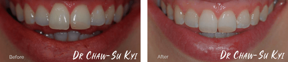 Invisalign before and after - case 1