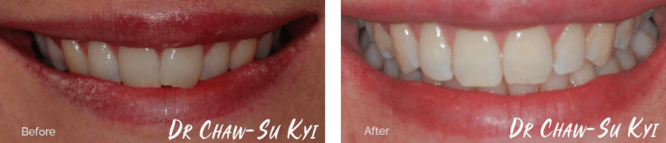 Before and after treatment - case 2