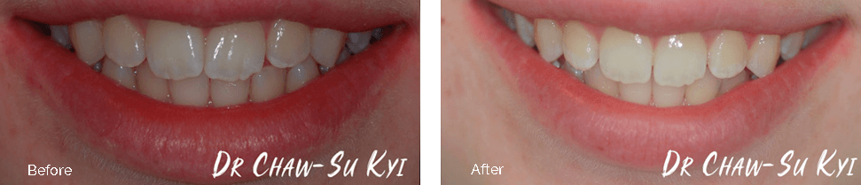 Invisalign Teen before and after