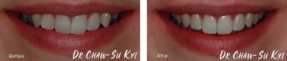 Before and after gapped teeth treatment - case 1
