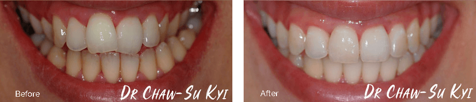 Before and after gapped teeth treatment - case 3