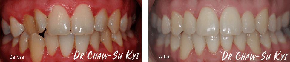 Invisalign before and after - case 4