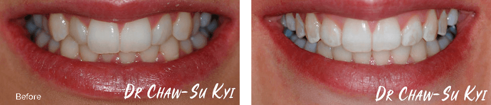 Invisalign before and after - case 5