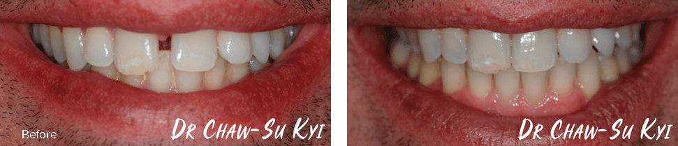 Invisalign before and after - case 6