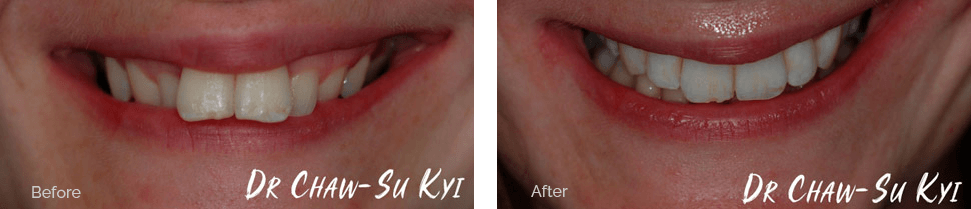 Before and after treatment - case 1