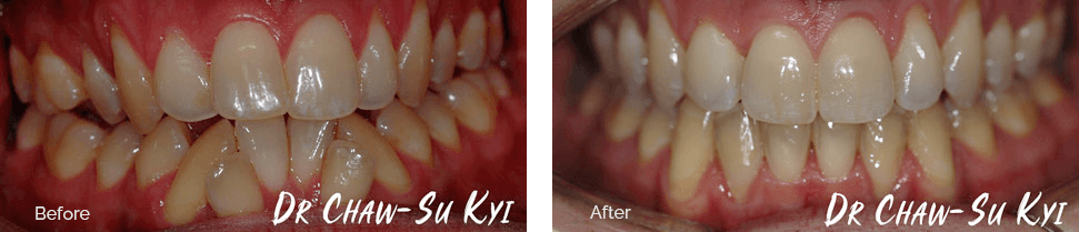 Before and after treatment - case 2