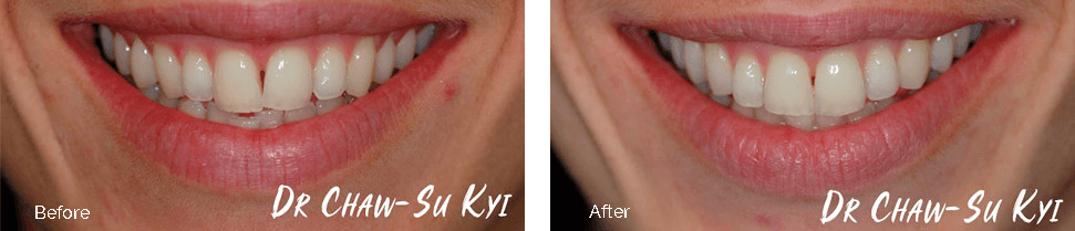 Before and after treatment - case 3