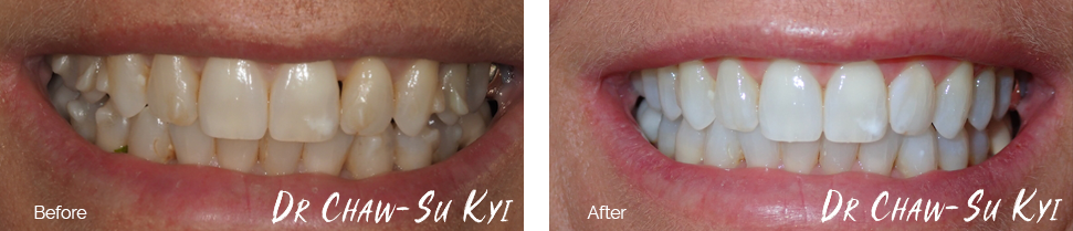 Teeth whitening before and after