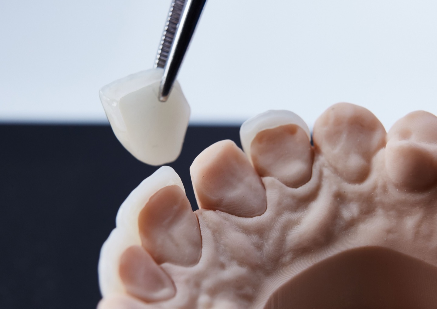 A porcelain veneer held above a model of the upper teeth